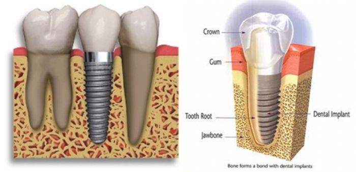Implante dental 4.2mm